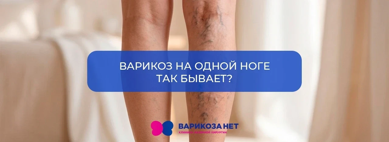 Варикоз на одной ноге так бывает?